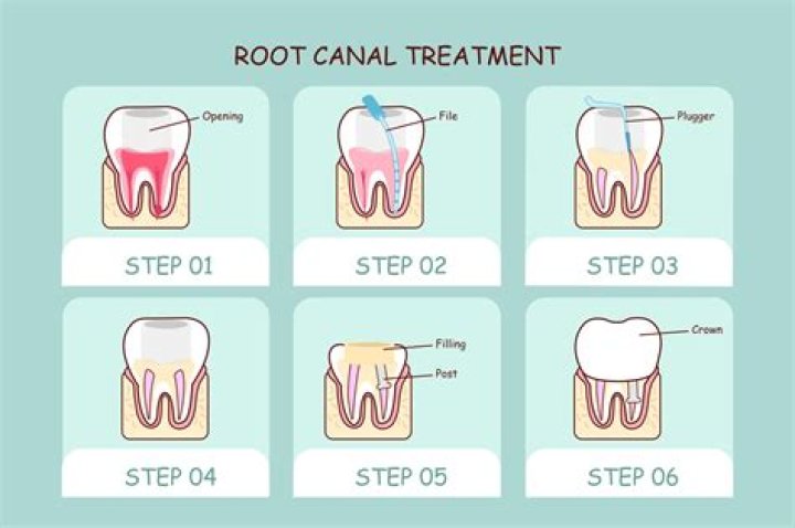 How do you do RCT step by step?