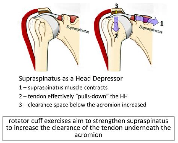 How do you fix supraspinatus impingement?