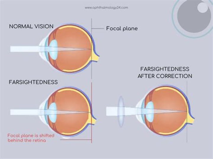 How do you permanently cure far sightedness?