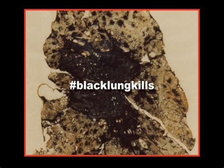 How do you qualify for black lung benefits?