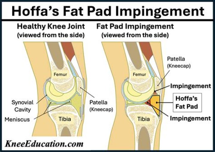 How do you treat a knee impingement?