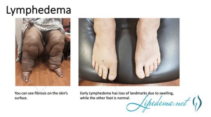 What does a lymphedema specialist do?