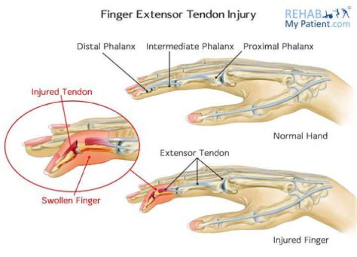 What does it feel like to tear a tendon in your finger?