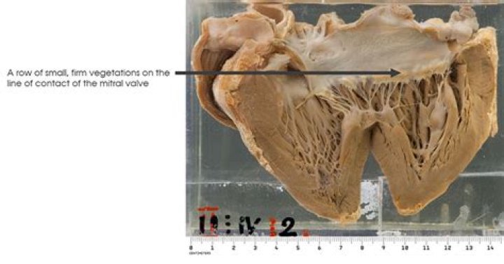 What is valvular vegetation?