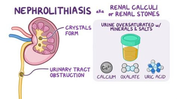 What treatment is used for nephrolithiasis?