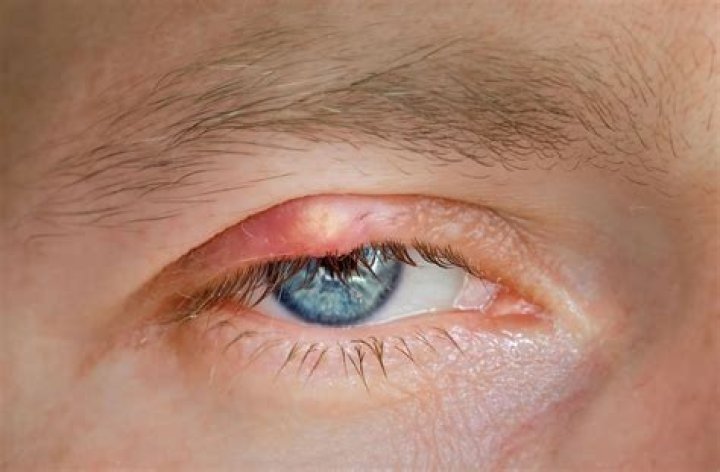 Why do I have a painful pimple on my eyelid?